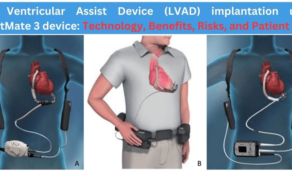 HeartMate 3 LVAD Technology